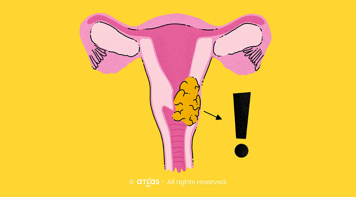 Cancerul de col uterin | Importanța diagnosticului precoce